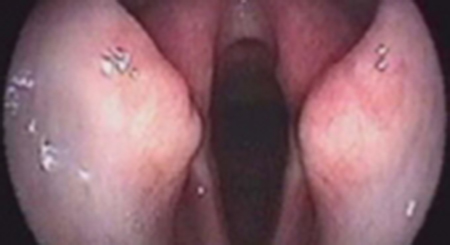 Endoscopia rigida